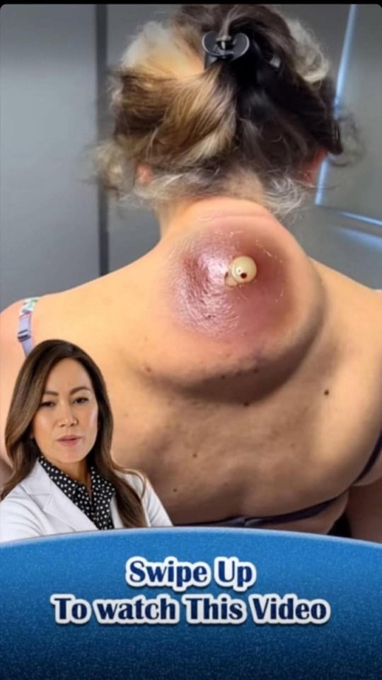She Ignored a Small Lump on Her Neck… Weeks Later Doctors Were Shocked by What They Had to Drain